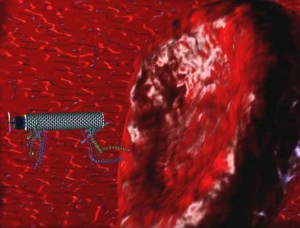 تتبع وتوجيه أسراب الروبوتات النانوية داخل الأوعية الدموية باستخدام تقنية LSCI: إمكانيات واعدة لتطبيقات طبية ثورية Nanobots12